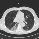 ANCA vasculitis, lung involvement: CT - Computed tomography